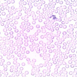 Pengertian Neutrofil, Jenis Sel Darah Putih